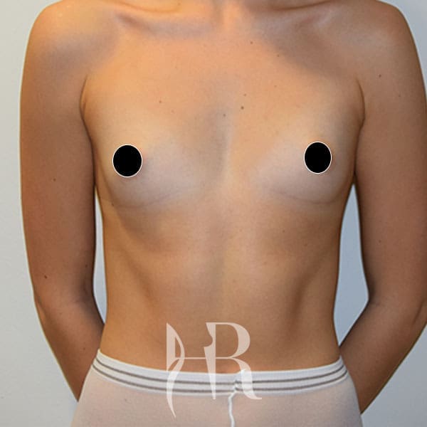 HR Plastic Surgery - Breast Enlargement patient before 4